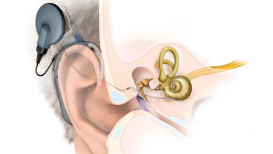 Photo of İşitme kaybı olan çocuklara iyi haber