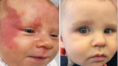 Photo of Yüzdeki ‘şarap lekesi’ lazerle tedavi edilebilir