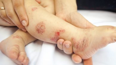 Photo of Kaşıntı deyip geçmeyin