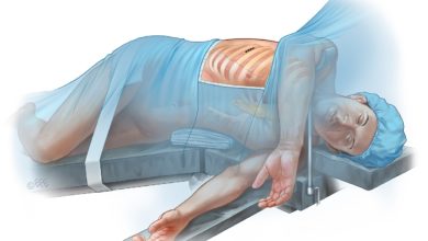 Photo of Akciğer kanserine kapalı ameliyat