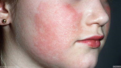 Photo of Altıncı Hastalık bulaşıcıdır