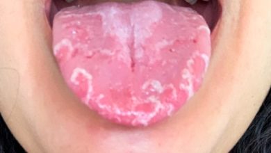 Photo of HPV virisü vücuttan tamamen atılır mı?