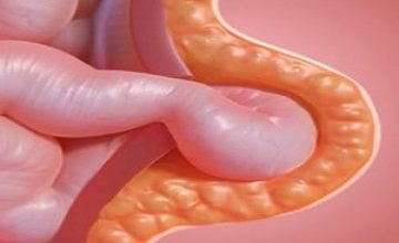 Photo of Kasık fıtığının 3 belirtisi