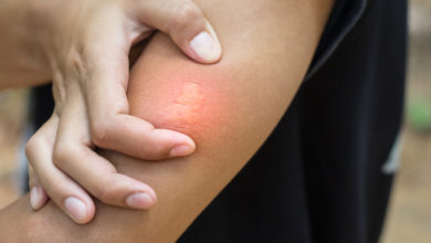 Photo of Böcek ısırırsa…