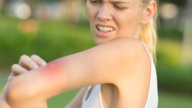 Photo of Böcek, sinek ve arı sokması…