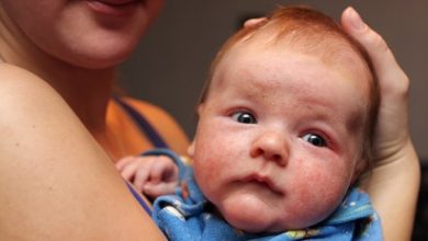 Photo of Atopik dermatitin 8 belirtisi