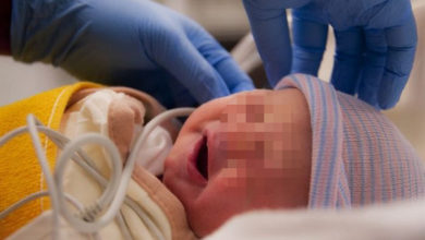 Photo of Hidrosefali her yaşta olabilir