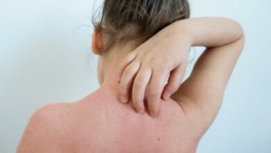 Photo of Cilt kaşıntısı nasıl giderilir?
