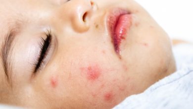 Photo of Coxsackie’nin belirtileri….