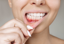 Photo of Ağızda geçmeyen yaralar neyin habercisi?