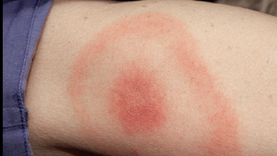 Photo of Öküz gözü gibi kızarıklık varsa…