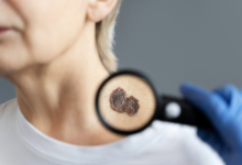 Photo of Cilt kanseri sinyal verir